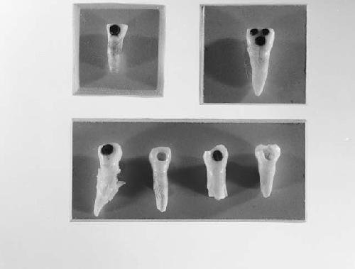 Six human teeth inlaid with pyrite