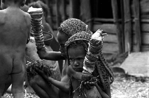 2 of the little girls and the women around them; hands all bandaged after having their fingers chopped off