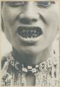 Bagobo woman with filed teeth