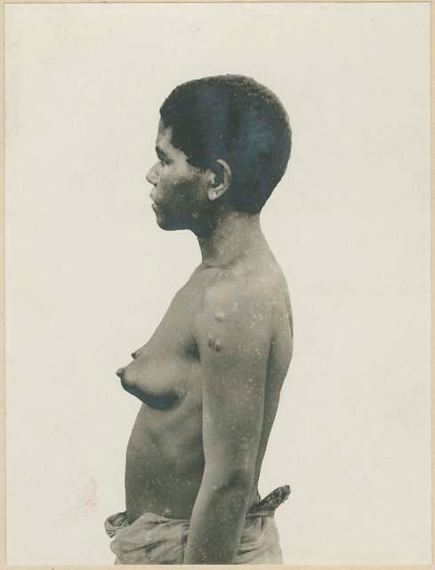 Profile of woman with scars on arm