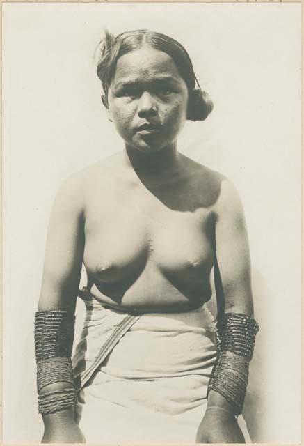 Tinguian woman wearing arm ornaments, with swollen arms