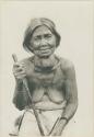 Tinguian woman with goitre