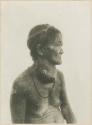 Tinguian woman suffering from bad goitre