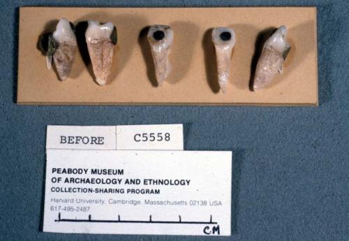 Human teeth inlaid with pyrite