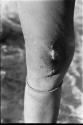 Person's knee with a scab