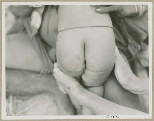 Child's buttocks, showing pigmented areas