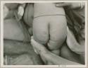 Child's buttocks, showing pigmented areas