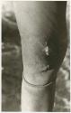 Person's knee with a scab (print is a cropped image)