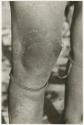 Person's knee with a scab (print is a cropped image)